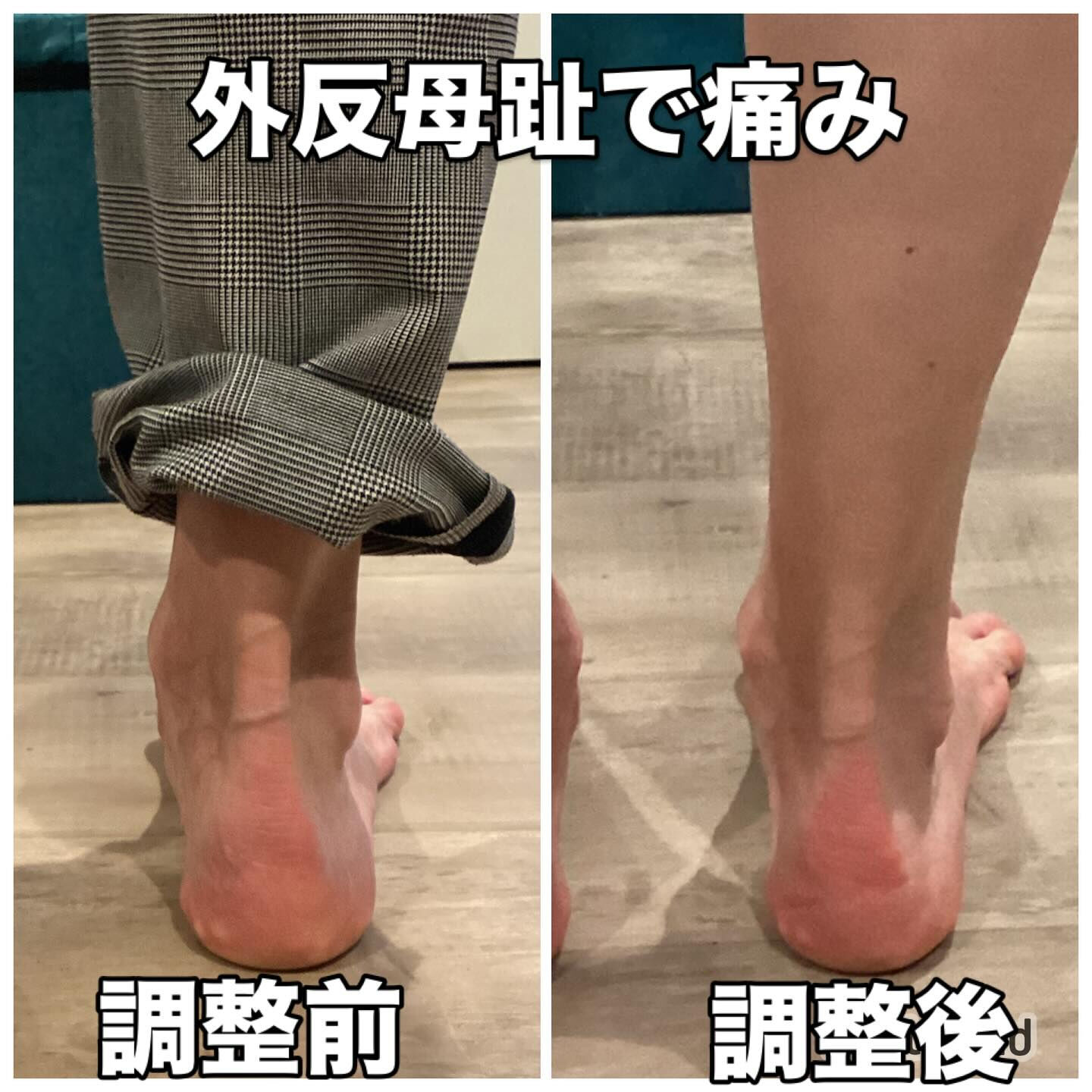 外反母趾の痛み！