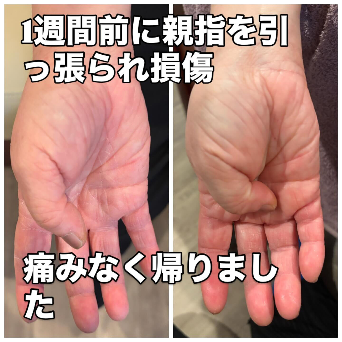 1週間前に親指を引っ張られ損傷し来店！