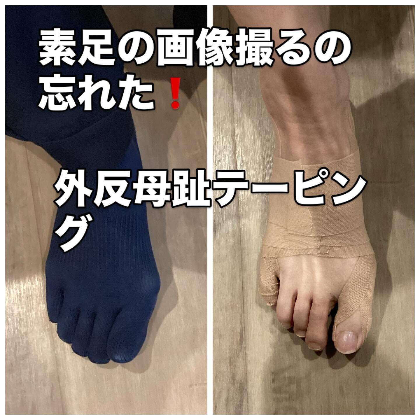 外反母趾テーピング❗️