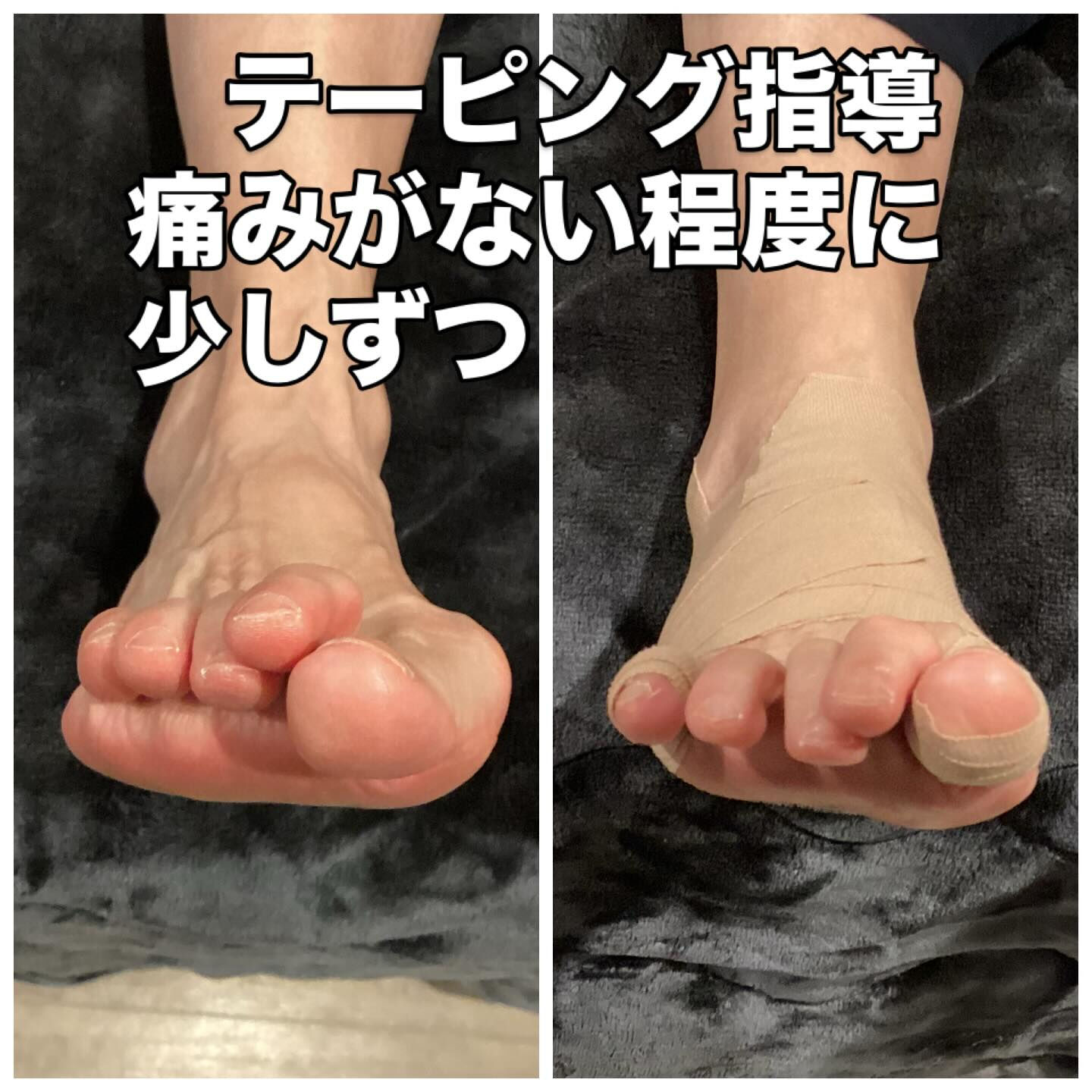 外反母趾の痛みなし！